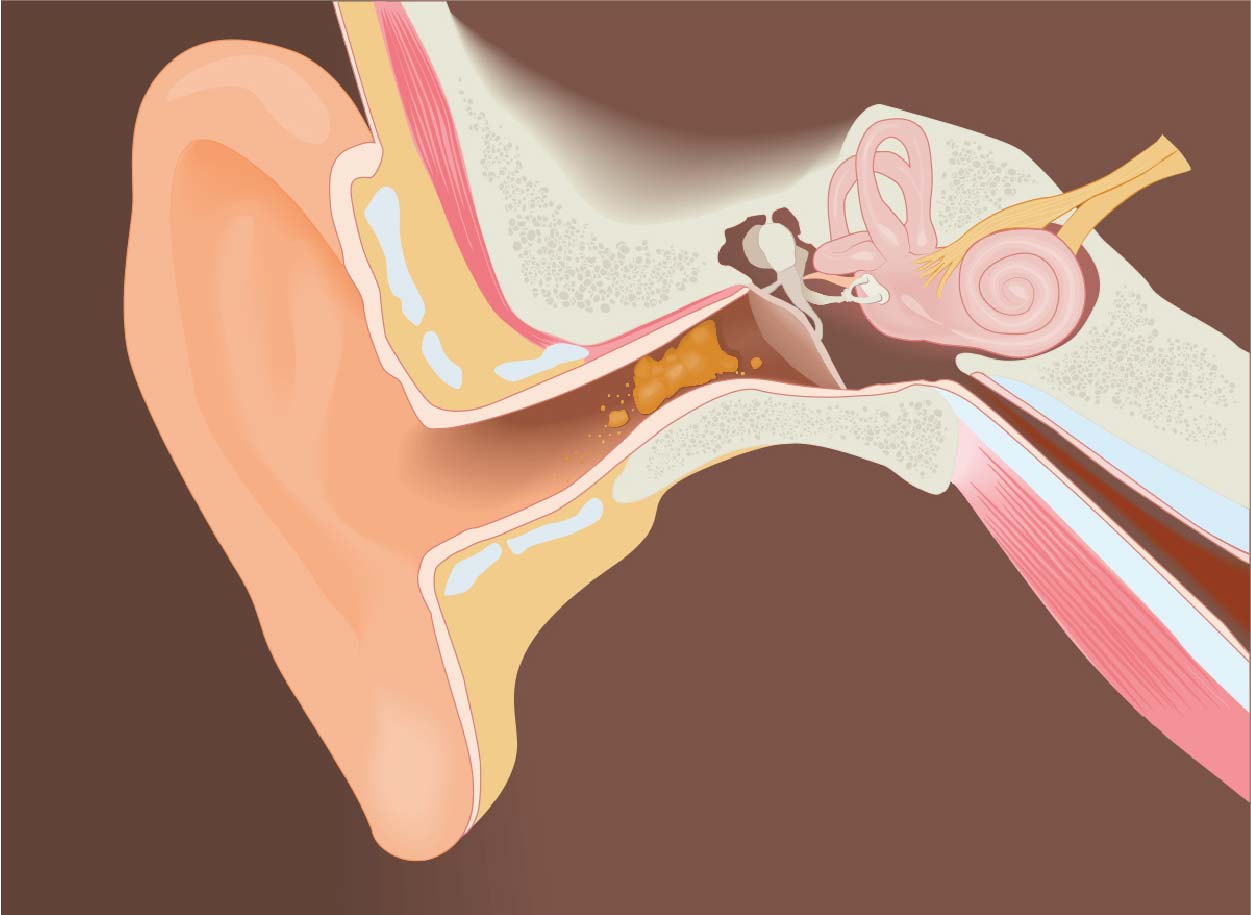 Is Earwax a Cause of Hearing Loss, and Is There an Easy Fix?