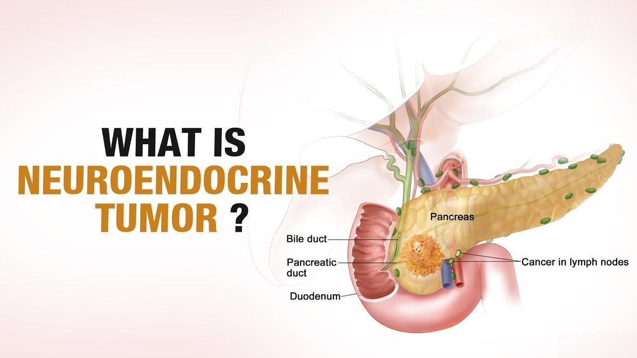 Neuroendocrine tumor (Carcinoid Cancer) Dr Faisal Dar