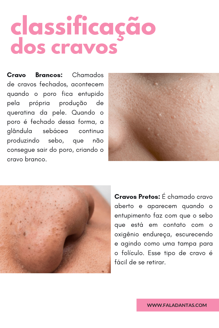 CRAVOS NO ROSTO Como remover? » Fala, DantasFala, Dantas