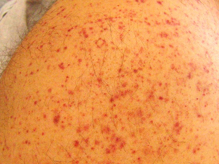 thrombocytopenia The Foot and Ankle Online Journal