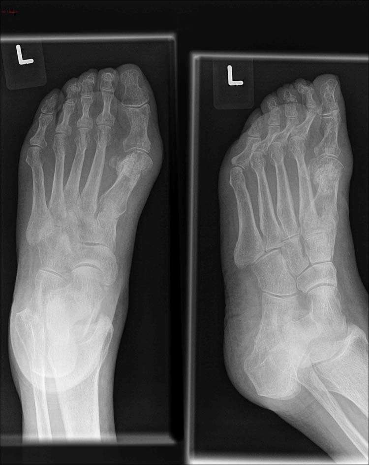 Mitchell’s bunionectomy