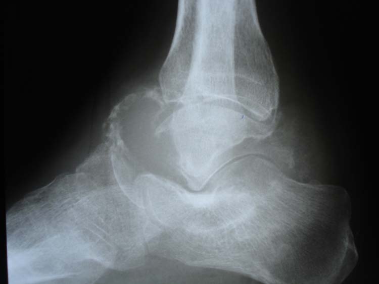 Giant Cell Tumor of Talus A case report of late presentation with