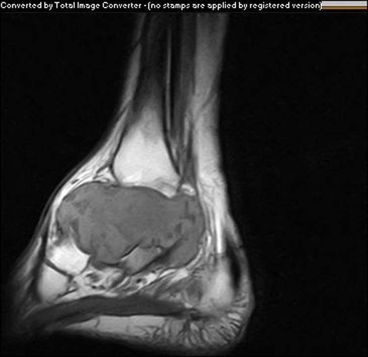 Giant Cell Tumor of Talus A case report of late presentation with