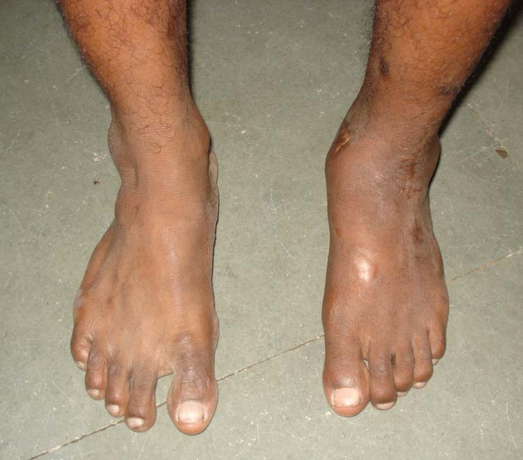 Giant Cell Tumor of Talus A case report of late presentation with