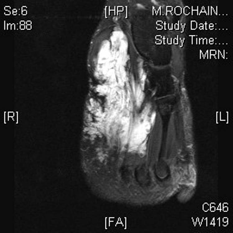 hemangioma The Foot and Ankle Online Journal