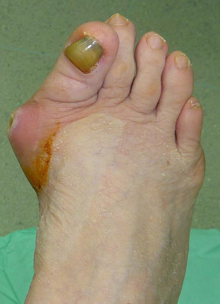 Percutaneous First Metatarsocuneiform Joint Arthrodesis Treatment of