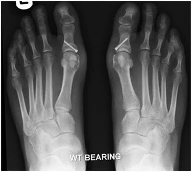 Akin osteotomy The Foot and Ankle Online Journal