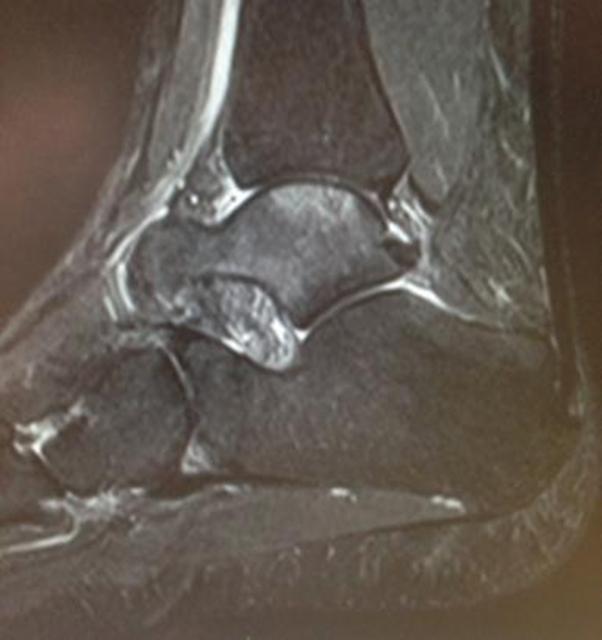 Subchondroplasty of the ankle A novel technique The Foot and Ankle
