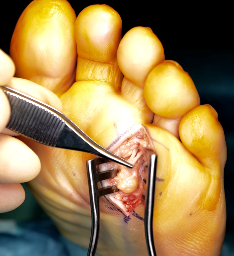 Long plantar access for interdigital perineural resection