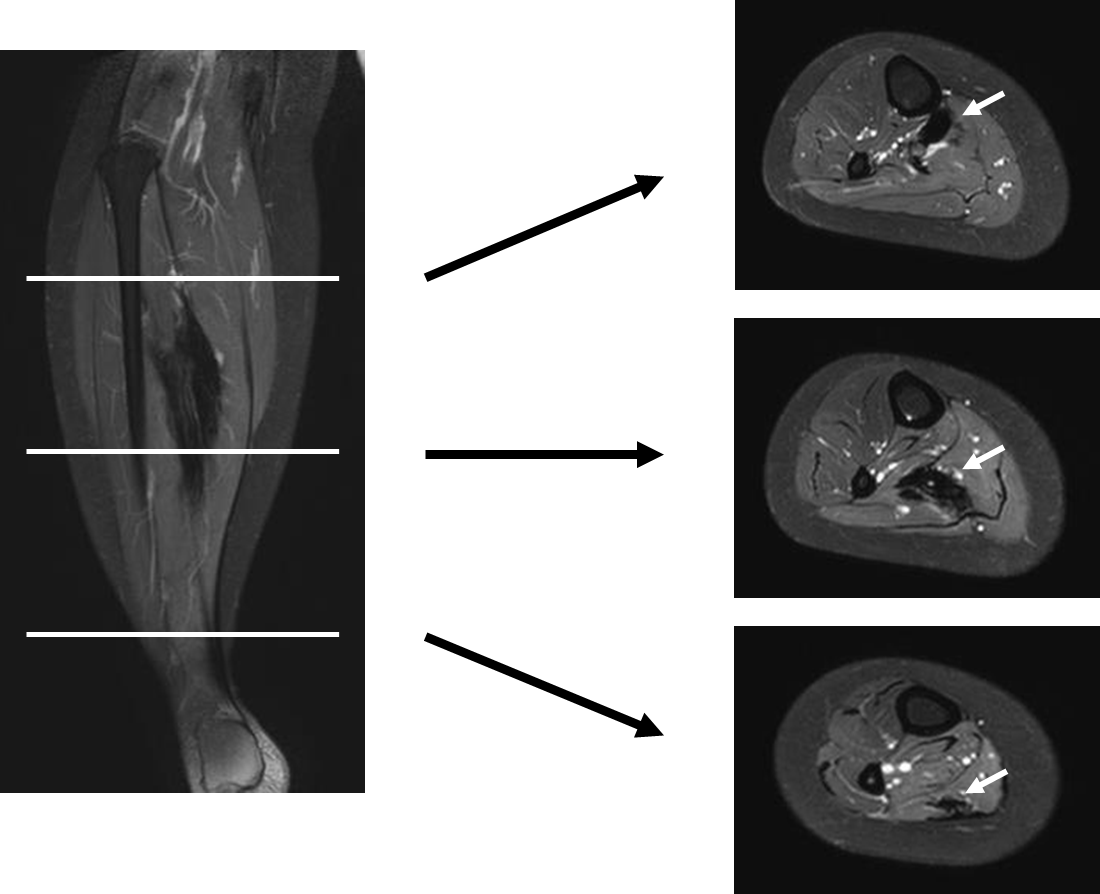 Fibromatosis of the soleus muscle presenting as pes equinus A case
