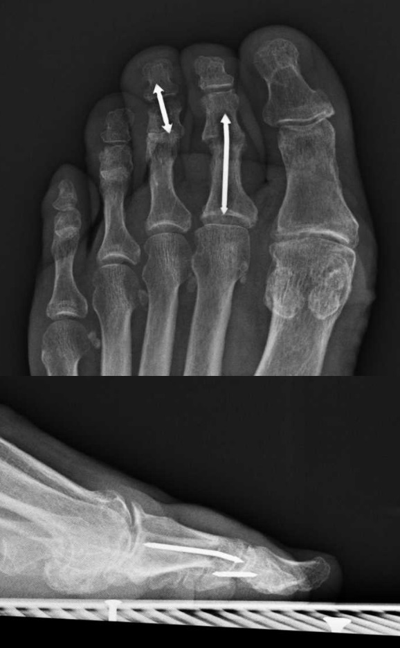 Intramedullary rodding of a toe hammertoe correction using an