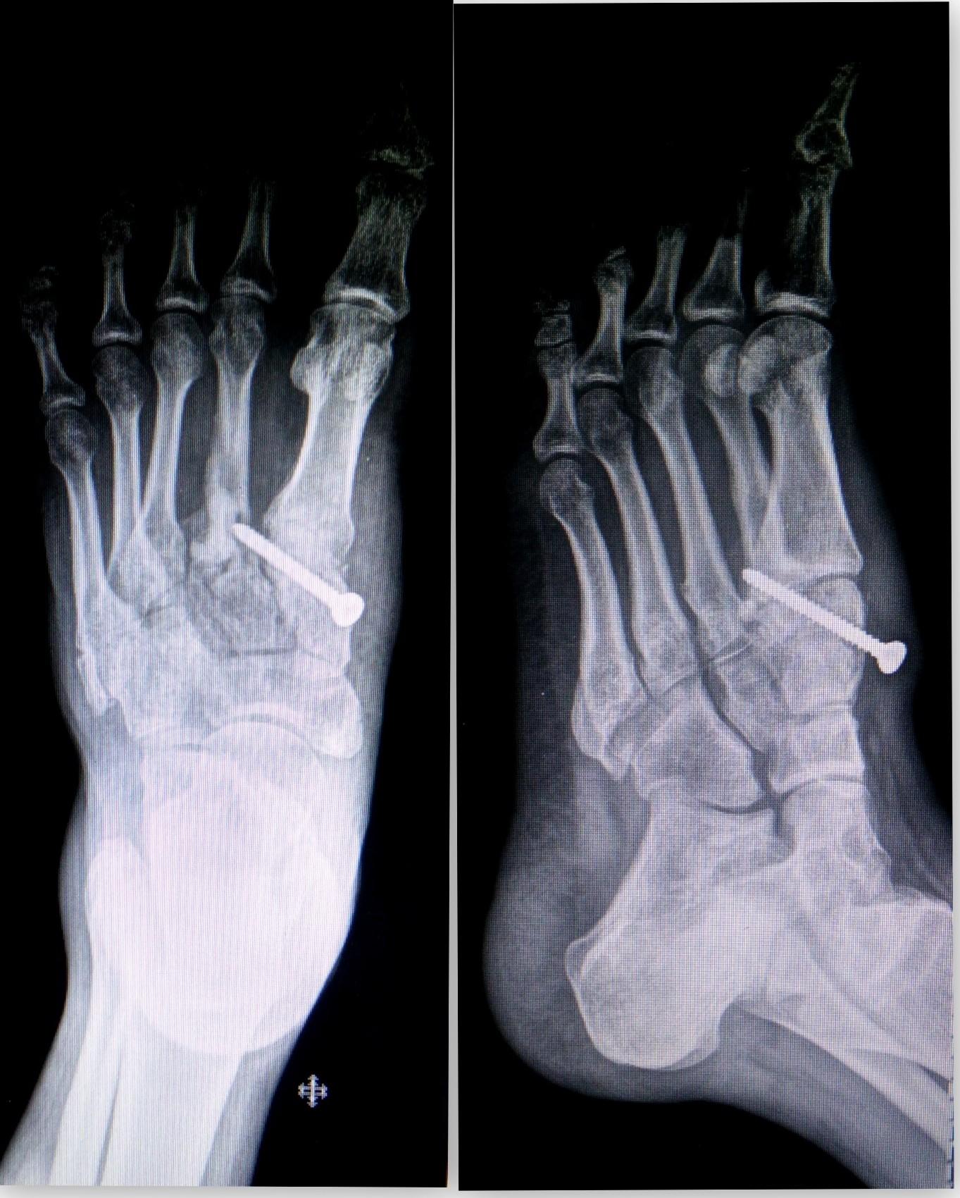 Lisfranc Injury Surgery : Divergent Lisfranc injury with dislocation of great toe ...