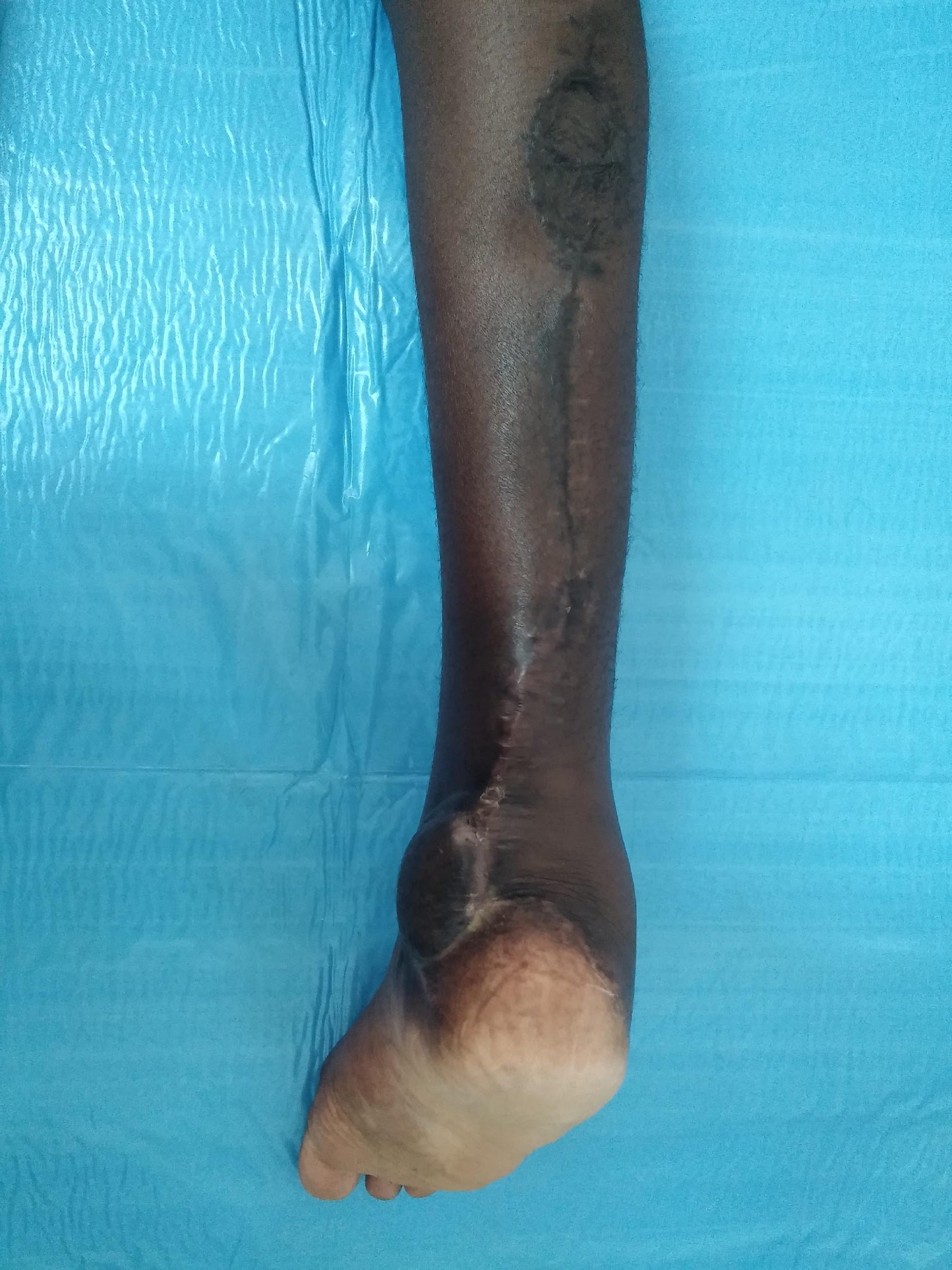 Heel spoke wheel injuries in a community hospital in Togo The Foot and Ankle Online Journal
