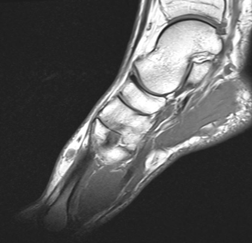 Benign schwannoma of the medial dorsal cutaneous nerve of the foot A