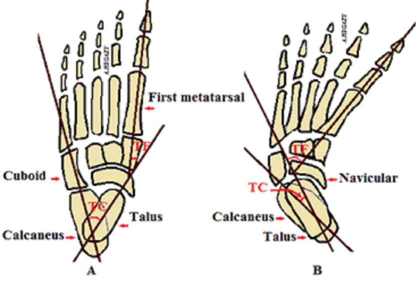 Clubfoot in children An overview The Foot and Ankle Online Journal