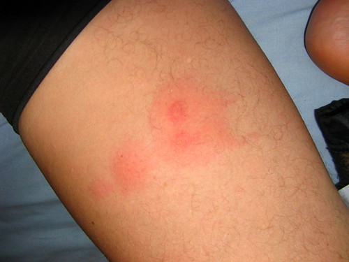 what is biting me? Netmums Chat
