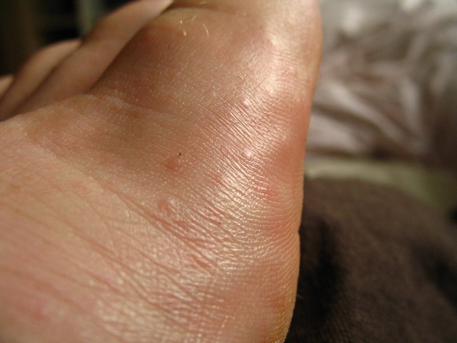 little bumps on foot Flickr Photo Sharing!