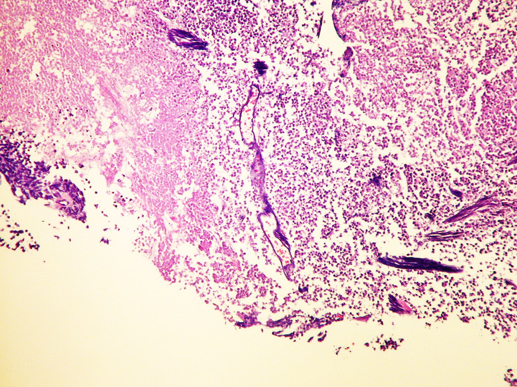 Tonofilaments Mesothelioma Creative Art