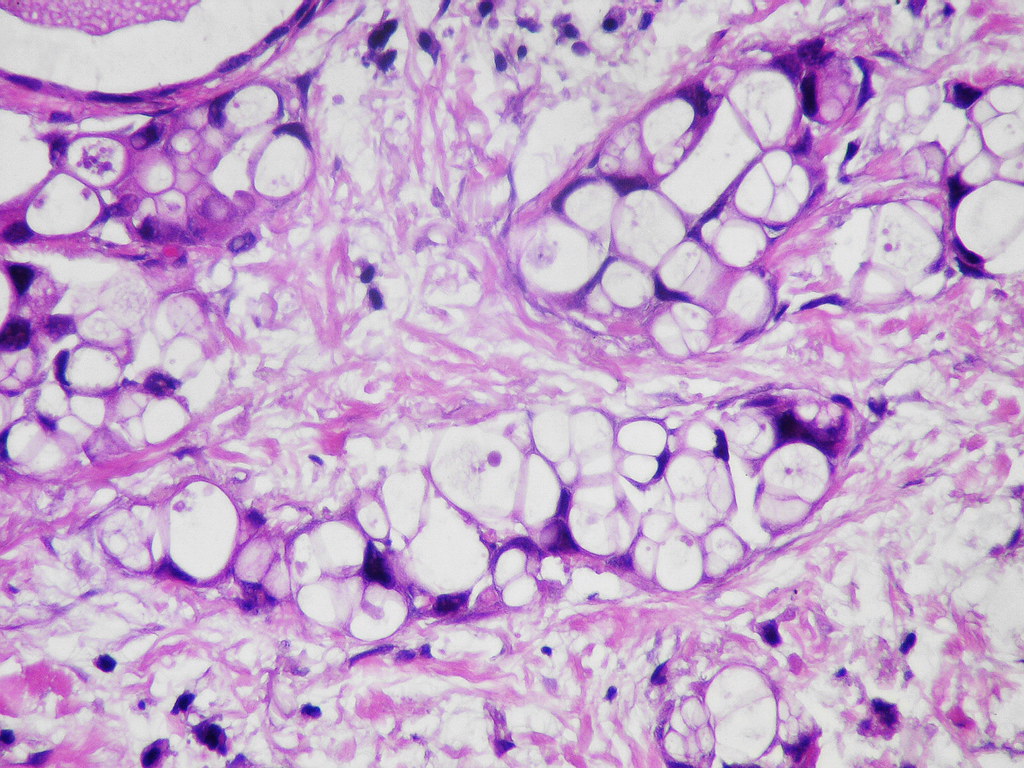 Tonofilaments Mesothelioma totenja