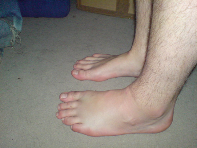 Another View Of My Swollen foot. a photo on Flickriver