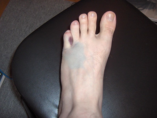 Plantar fasciitis treatment massage, inserts in running shoes, plantar