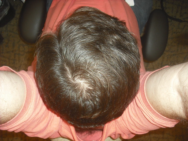 I have a bald spot! Flickr Photo Sharing!