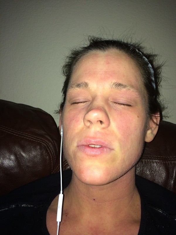 Peace Out Eczema Day 141 Day 149 Showering, Allergic Reactions, Faster Healing, Moisturizer