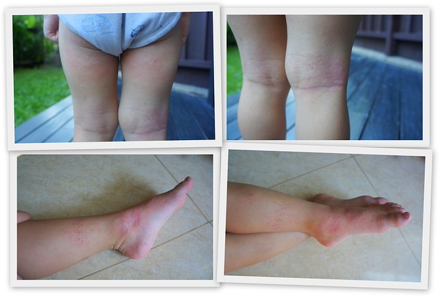 Dealing with dry, eczemaprone skin with Mustela STELATOPIA Post Script