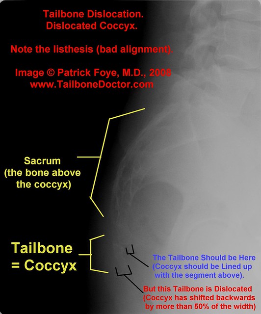 Tailbone dislocation, dislocated coccyx Flickr Photo