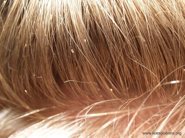 Head Lice Nits on Hair Flickr Photo Sharing!