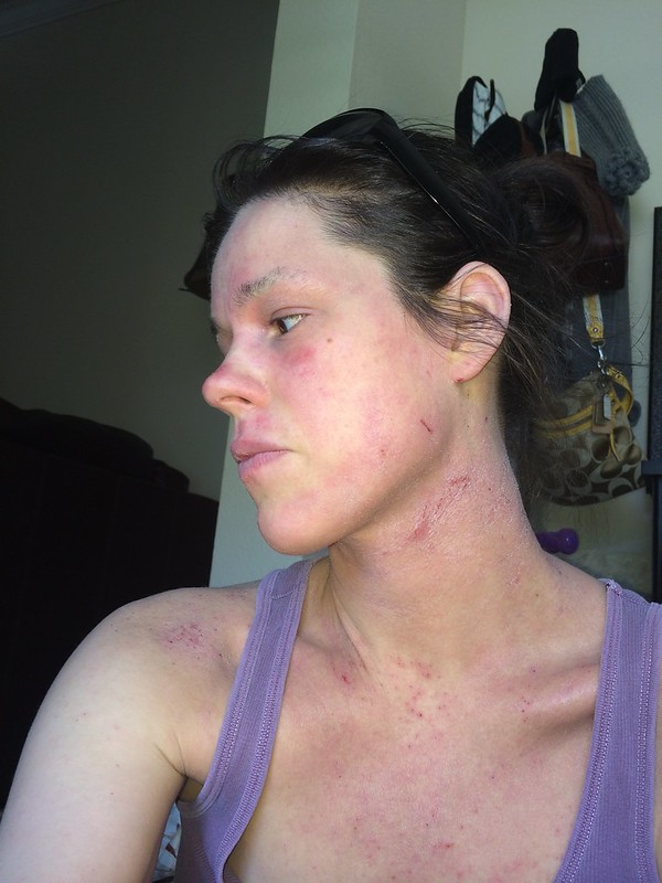 Peace Out Eczema Day 141 Day 149 Showering, Allergic Reactions, Faster Healing, Moisturizer