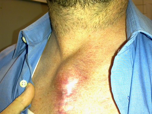 post surgical complications and feelings (some may find images