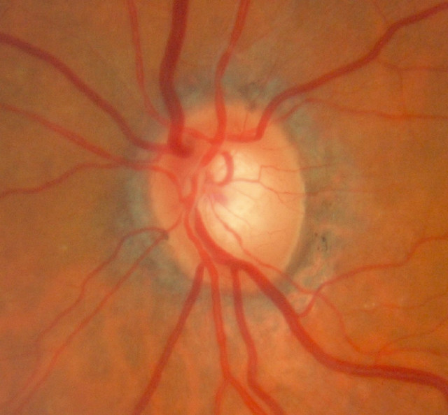 optic nerve head of a patient with pseudoexfoliation