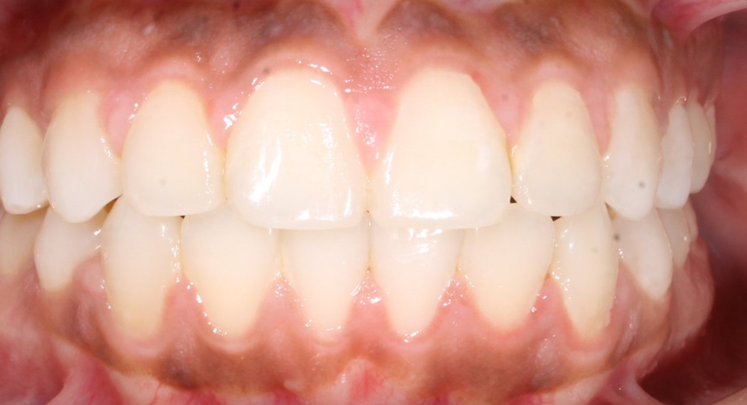 Before & Afters Oklahoma City Braces Edmond Invisalign