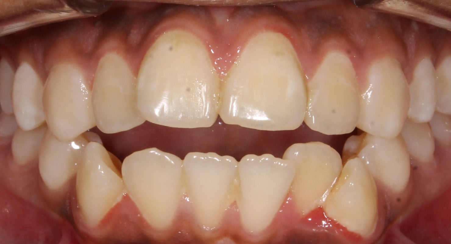 Before & Afters Oklahoma City Braces Edmond Invisalign