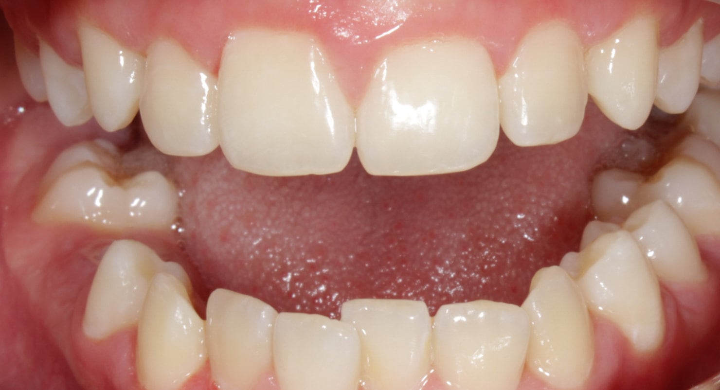 Before & Afters Oklahoma City Braces Edmond Invisalign