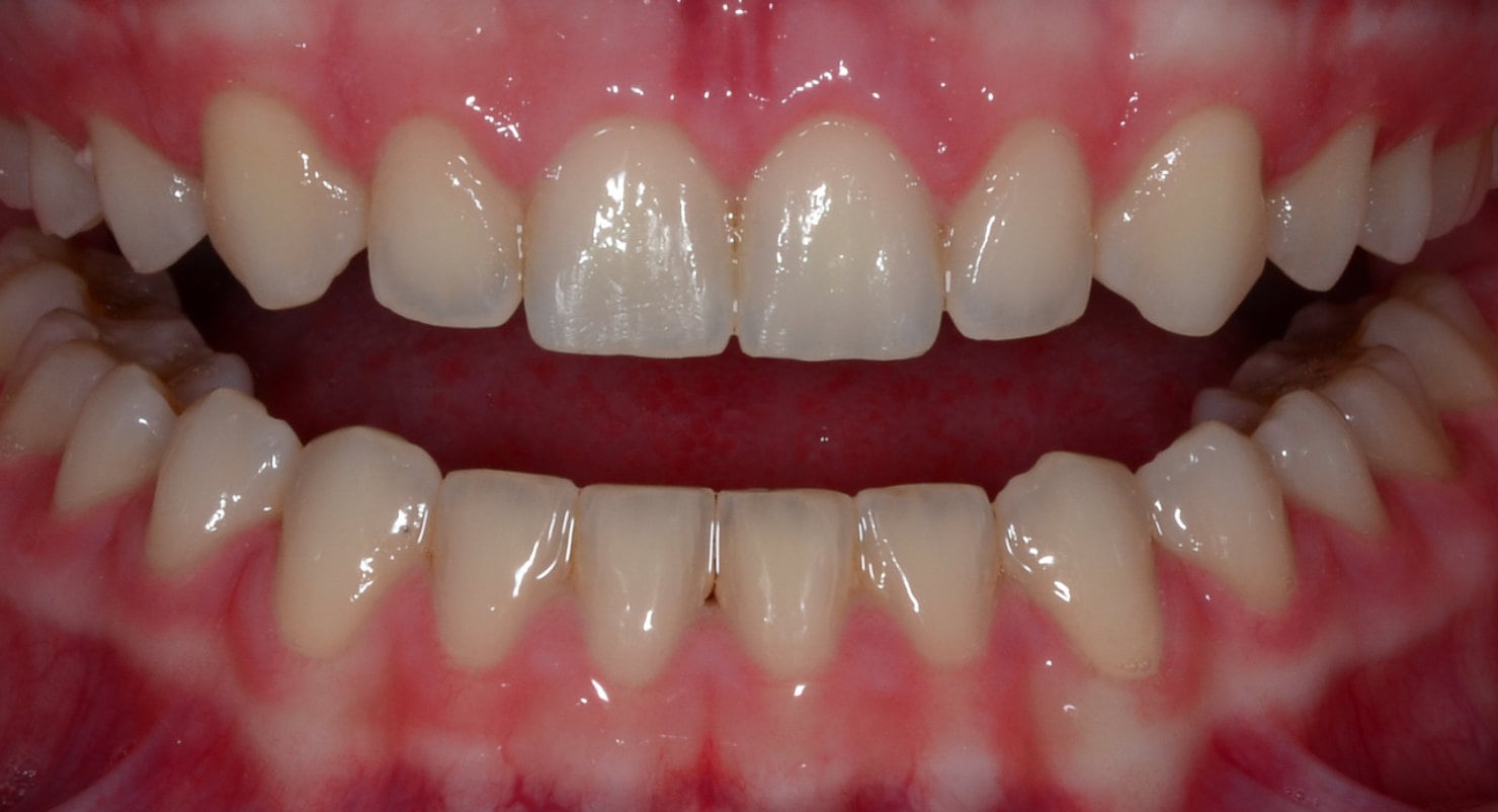 Before & Afters Oklahoma City Braces Edmond Invisalign