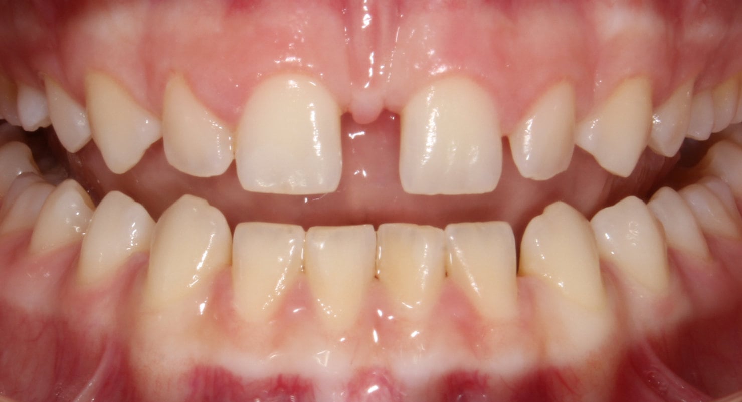 Before & Afters Oklahoma City Braces Edmond Invisalign