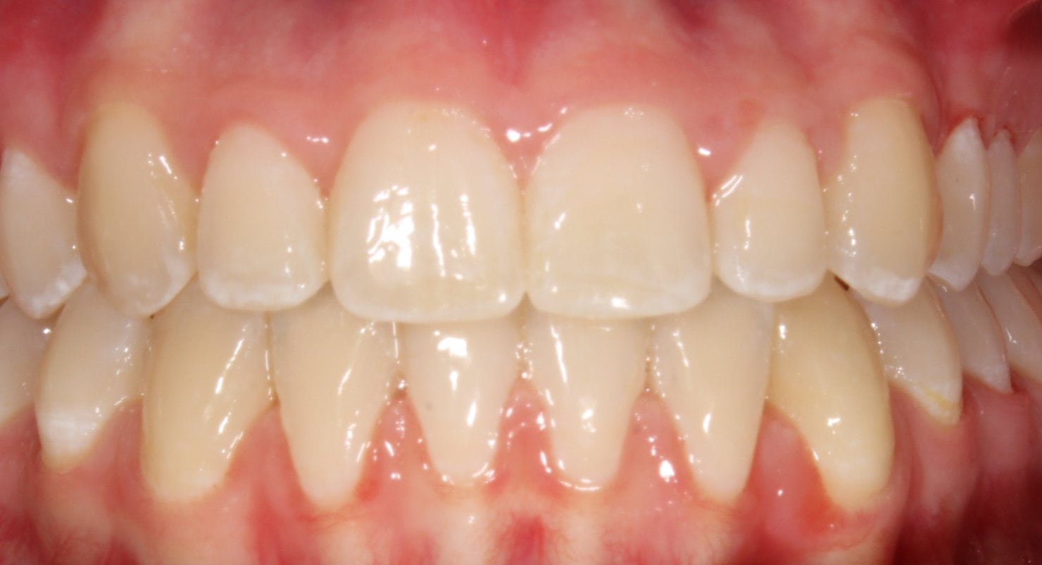 Before & Afters Oklahoma City Braces Edmond Invisalign