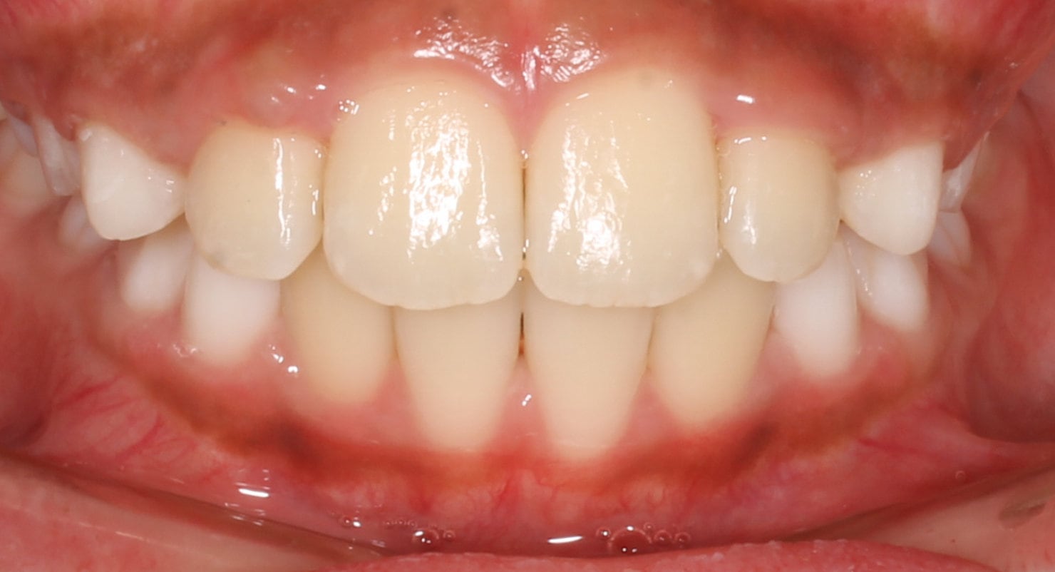 Before & Afters Oklahoma City Braces Edmond Invisalign