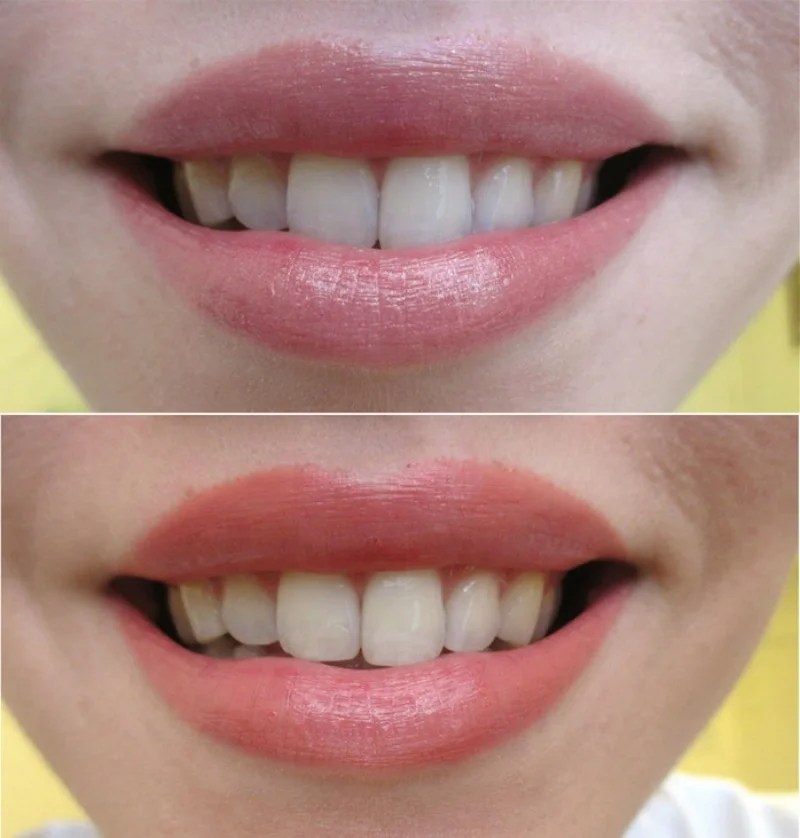 Best Colour Lipstick For Yellow Teeth