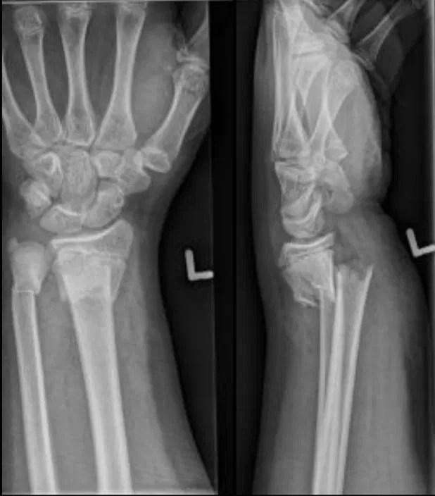 Colle Fracture Distal Radial Fracture Radiology Case RadioGyan