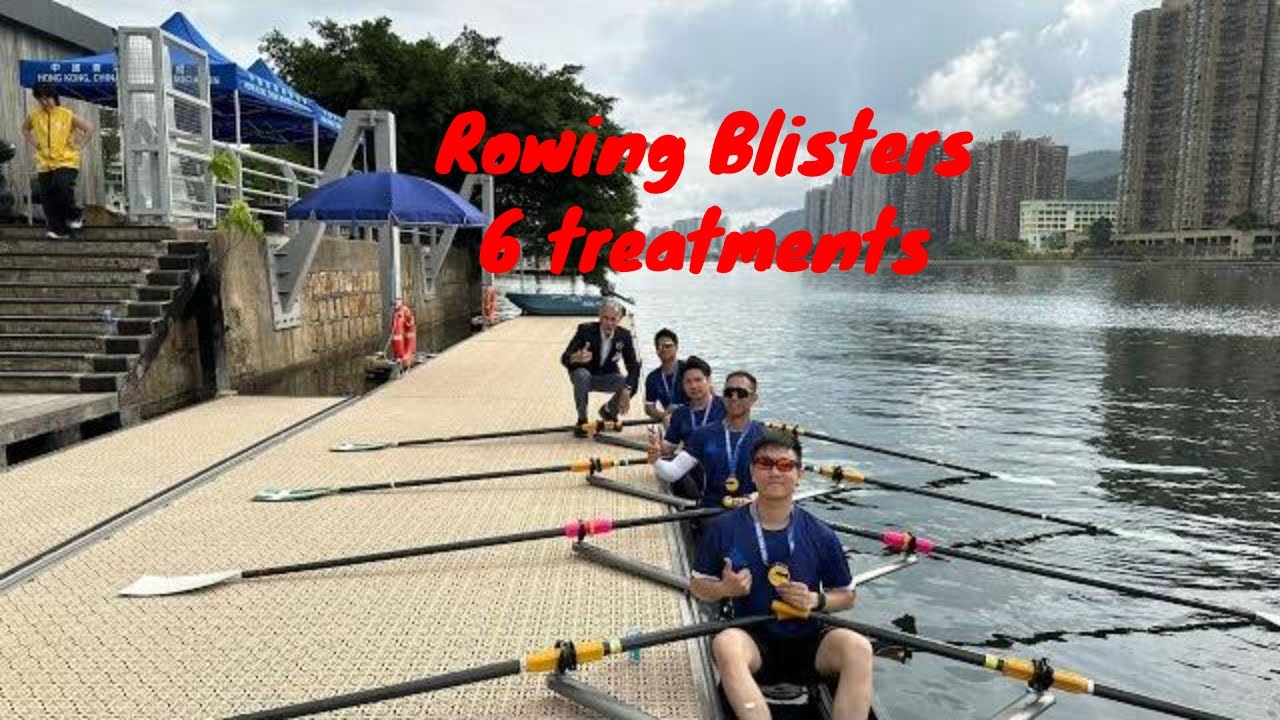 Rowing blisters 6 ways to treat them Faster Masters Rowing™