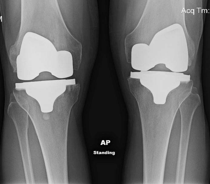 Masters Minds Life at 71 on Two Artificial Knees 2019 World Masters