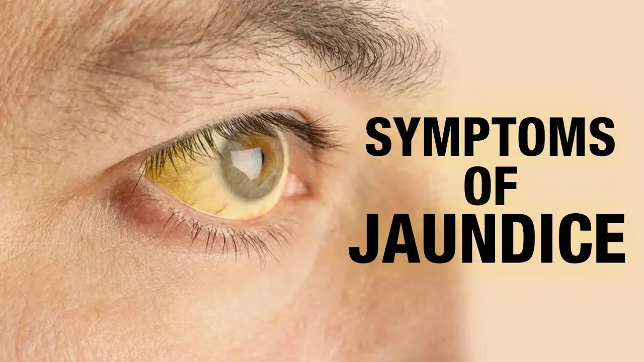 [Review] Best products to treat jaundice Fatty Liver Guide