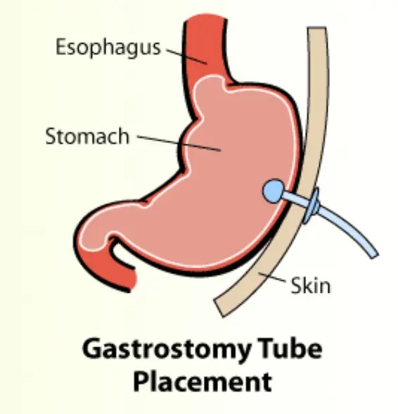Gastrostomy Tube