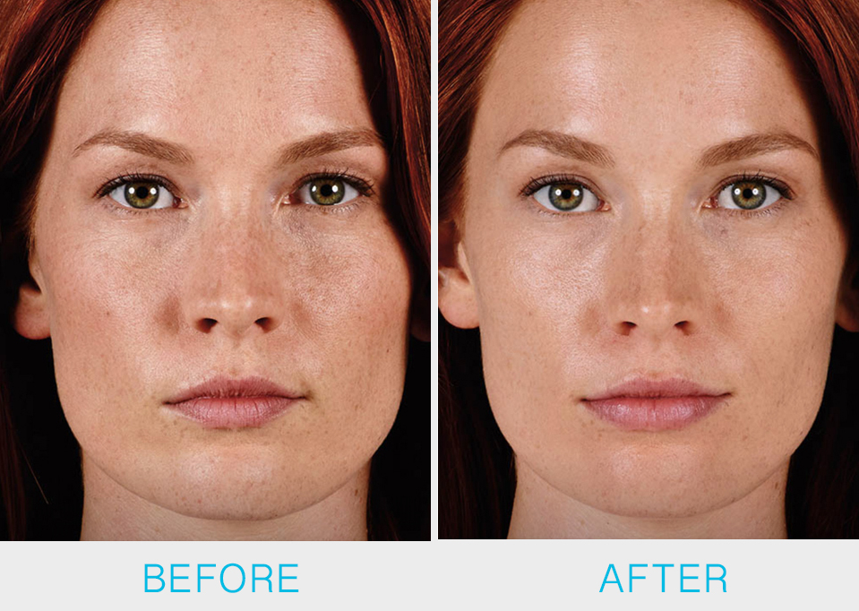 FC Skin Solution Clinic Lip Injections Vancouver All About Lips