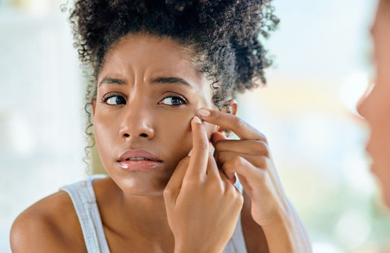 FC Skin Solution Clinic Stress Induced Acne Vancouver