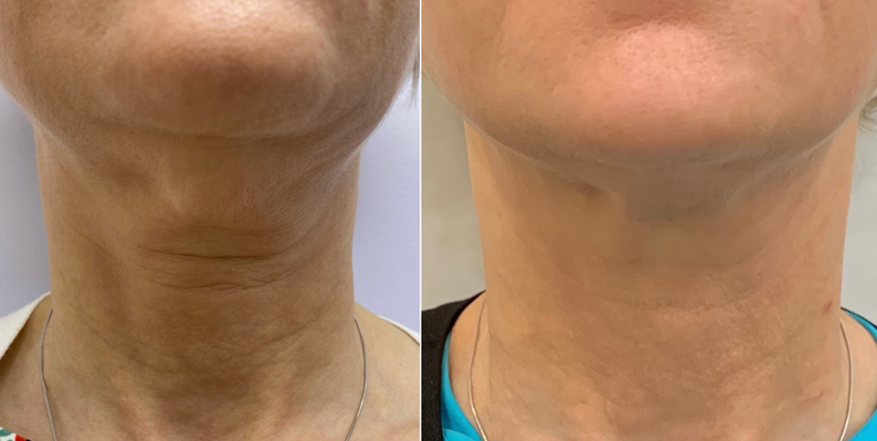 Radiesse Neck Lift FC Skin Solution Clinic Vancouver Medispa