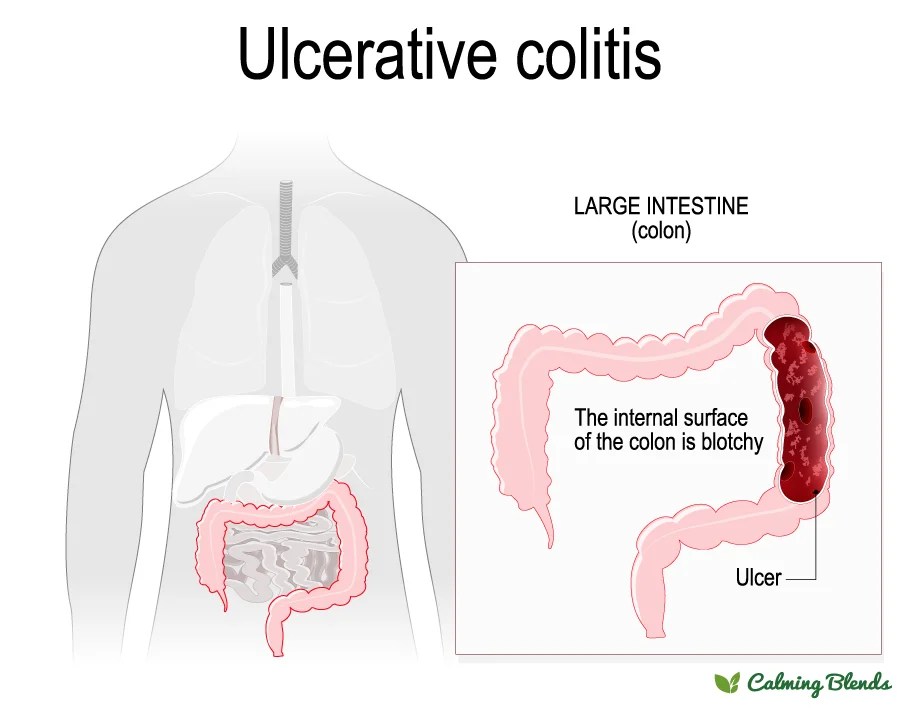 Colitis Tea Feel Better Digestive Tea